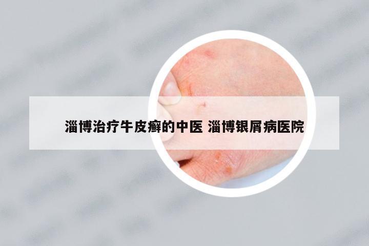 淄博治療牛皮癬的中醫(yī) 淄博銀屑病醫(yī)院