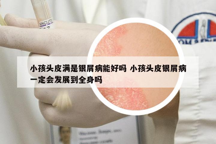 小孩頭皮滿是銀屑病能好嗎 小孩頭皮銀屑病一定會發(fā)展到全身嗎