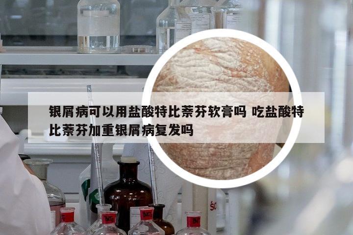 銀屑病可以用鹽酸特比萘芬軟膏嗎 吃鹽酸特比萘芬加重銀屑病復(fù)發(fā)嗎