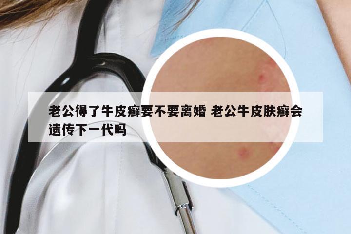 老公得了牛皮癬要不要離婚 老公牛皮膚癬會(huì)遺傳下一代嗎