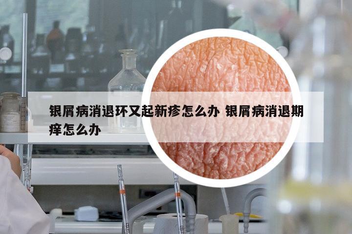 銀屑病消退環(huán)又起新疹怎么辦 銀屑病消退期癢怎么辦