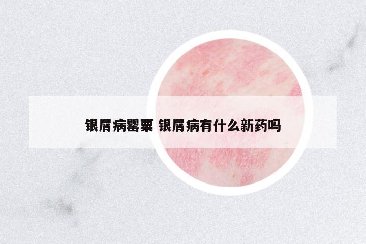 銀屑病罌粟 銀屑病有什么新藥嗎