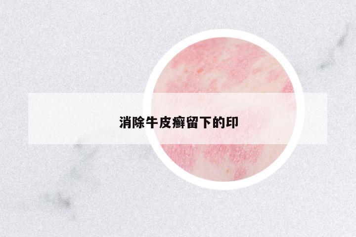 消除牛皮癬留下的印