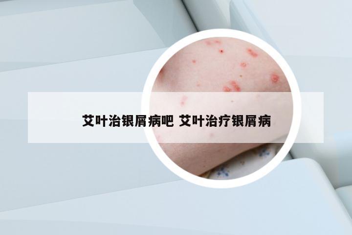艾葉治銀屑病吧 艾葉治療銀屑病