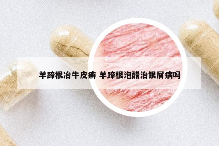 羊蹄根冶牛皮癬 羊蹄根泡醋治銀屑病嗎