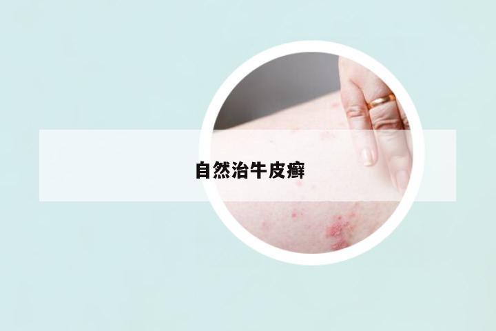 自然治牛皮癬