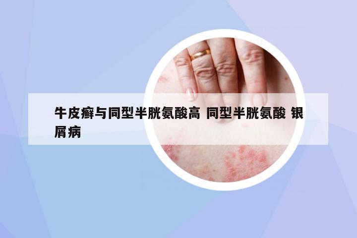 牛皮癬與同型半胱氨酸高 同型半胱氨酸 銀屑病