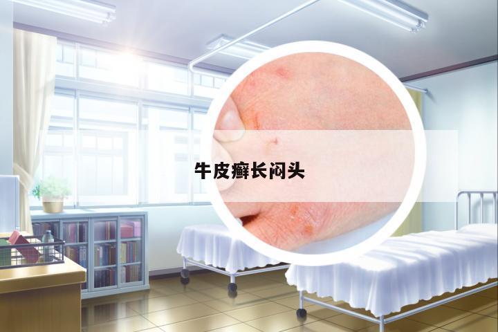 牛皮癬長悶頭