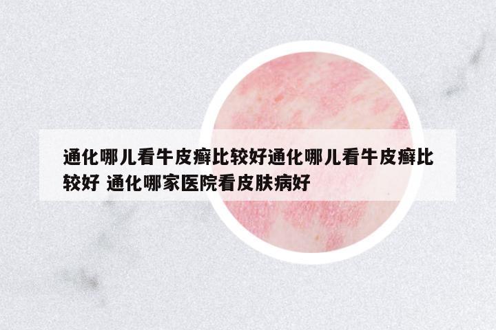 通化哪兒看牛皮癬比較好通化哪兒看牛皮癬比較好 通化哪家醫(yī)院看皮膚病好
