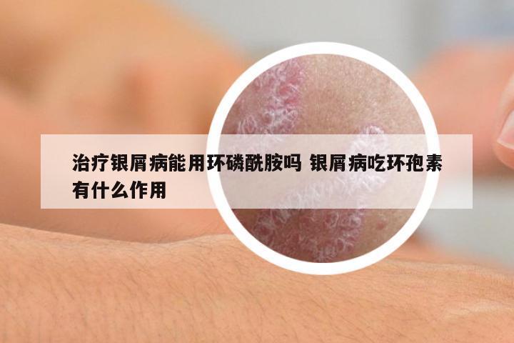 治療銀屑病能用環(huán)磷酰胺嗎 銀屑病吃環(huán)孢素有什么作用