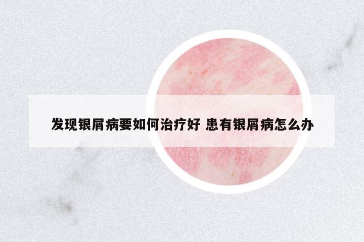 發(fā)現銀屑病要如何治療好 患有銀屑病怎么辦
