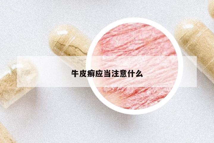 牛皮癬應(yīng)當(dāng)注意什么