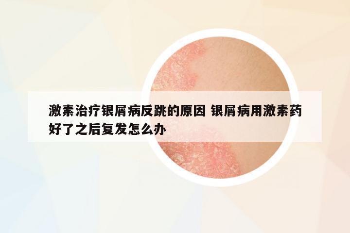 激素治療銀屑病反跳的原因 銀屑病用激素藥好了之后復發(fā)怎么辦
