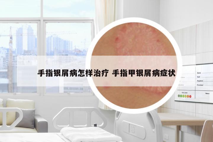手指銀屑病怎樣治療 手指甲銀屑病癥狀