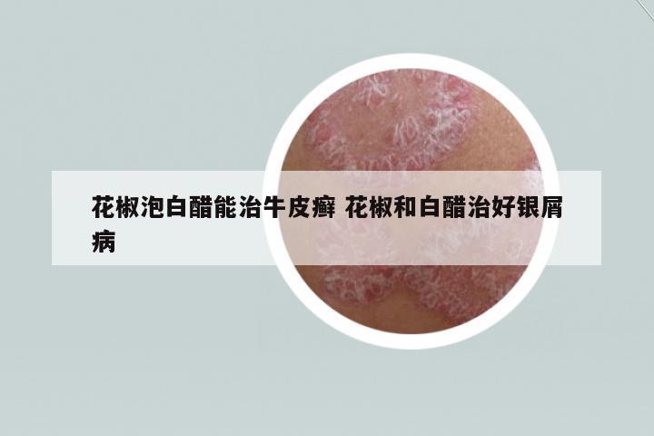 花椒泡白醋能治牛皮癬 花椒和白醋治好銀屑病