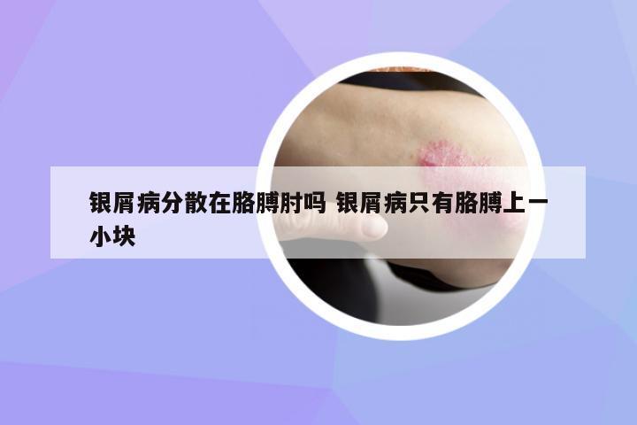 銀屑病分散在胳膊肘嗎 銀屑病只有胳膊上一小塊