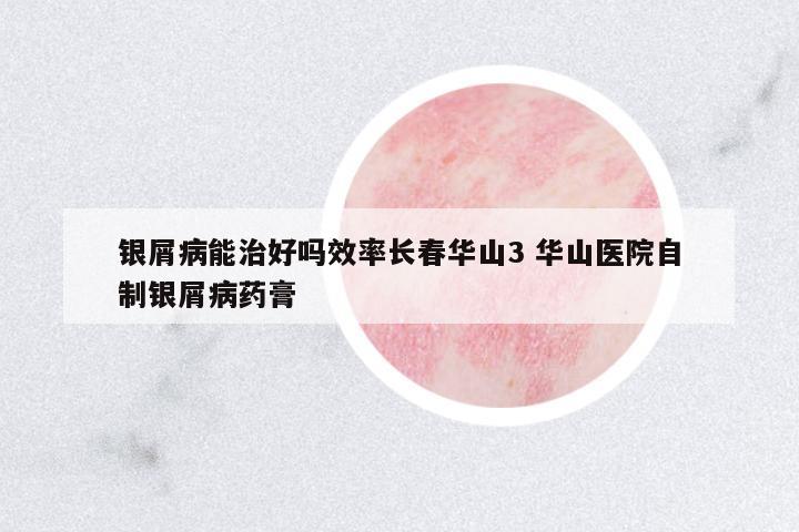 銀屑病能治好嗎效率長春華山3 華山醫(yī)院自制銀屑病藥膏