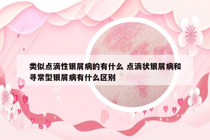 類(lèi)似點(diǎn)滴性銀屑病的有什么 點(diǎn)滴狀銀屑病和尋常型銀屑病有什么區(qū)別