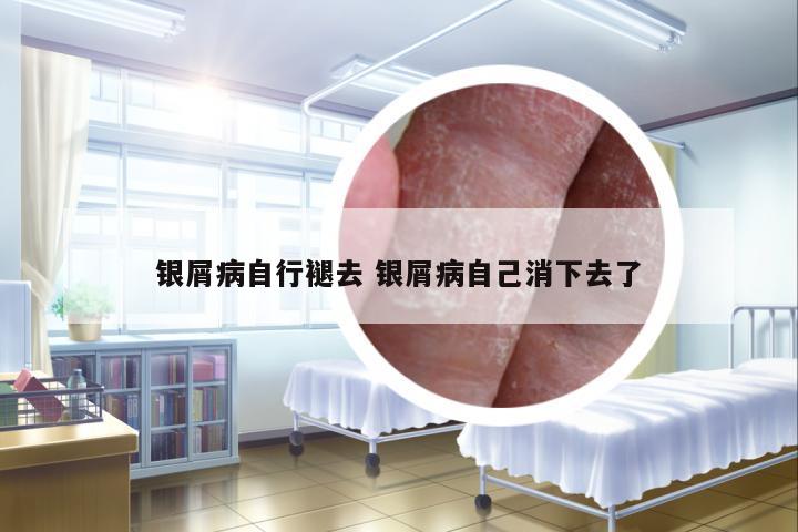 銀屑病自行褪去 銀屑病自己消下去了