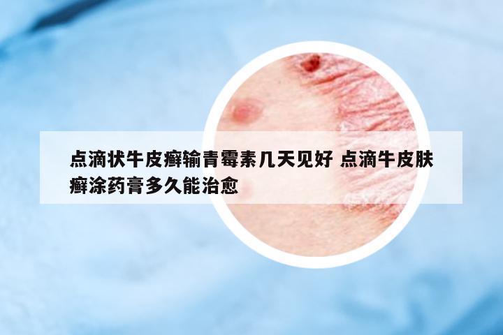 點滴狀牛皮癬輸青霉素幾天見好 點滴牛皮膚癬涂藥膏多久能治愈