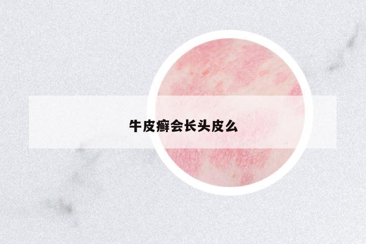 牛皮癬會長頭皮么