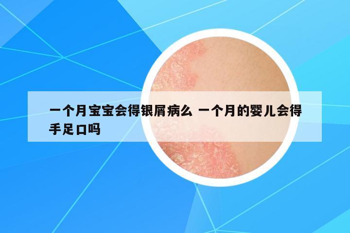 一個(gè)月寶寶會(huì)得銀屑病么 一個(gè)月的嬰兒會(huì)得手足口嗎