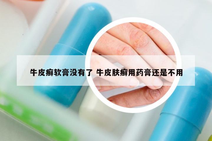 牛皮癬軟膏沒有了 牛皮膚癬用藥膏還是不用