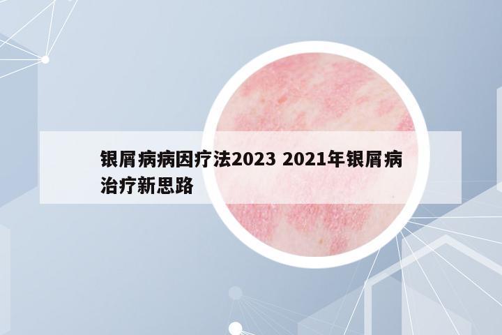 銀屑病病因療法2023 2021年銀屑病治療新思路