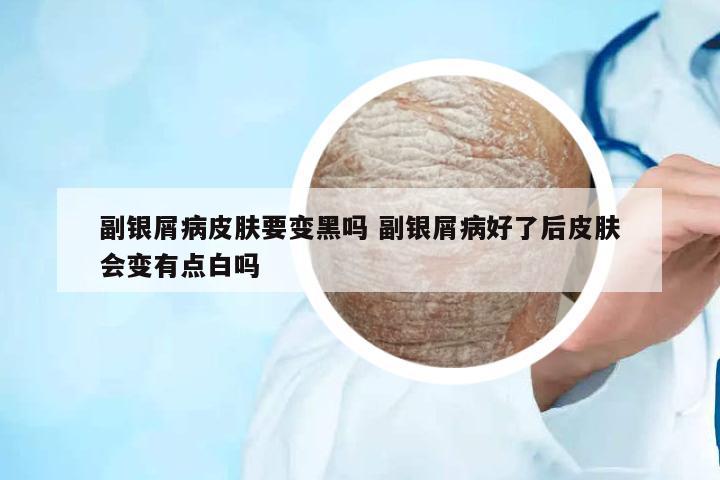 副銀屑病皮膚要變黑嗎 副銀屑病好了后皮膚會變有點(diǎn)白嗎