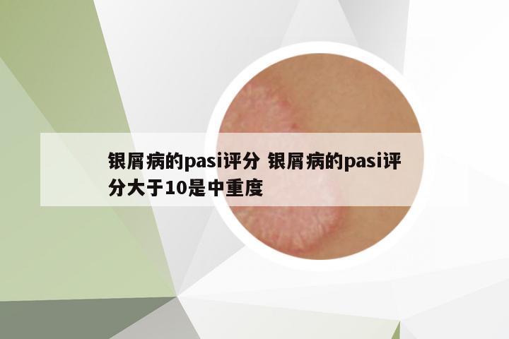 銀屑病的pasi評(píng)分 銀屑病的pasi評(píng)分大于10是中重度