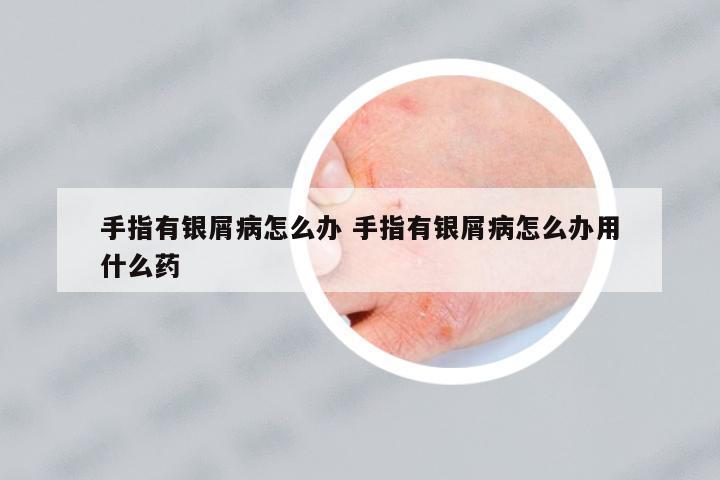 手指有銀屑病怎么辦 手指有銀屑病怎么辦用什么藥