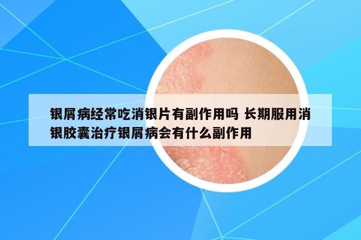 銀屑病經常吃消銀片有副作用嗎 長期服用消銀膠囊治療銀屑病會有什么副作用