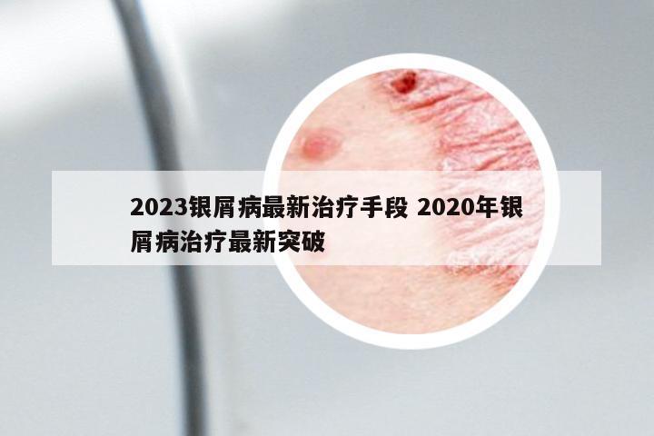 2023銀屑病最新治療手段 2020年銀屑病治療最新突破