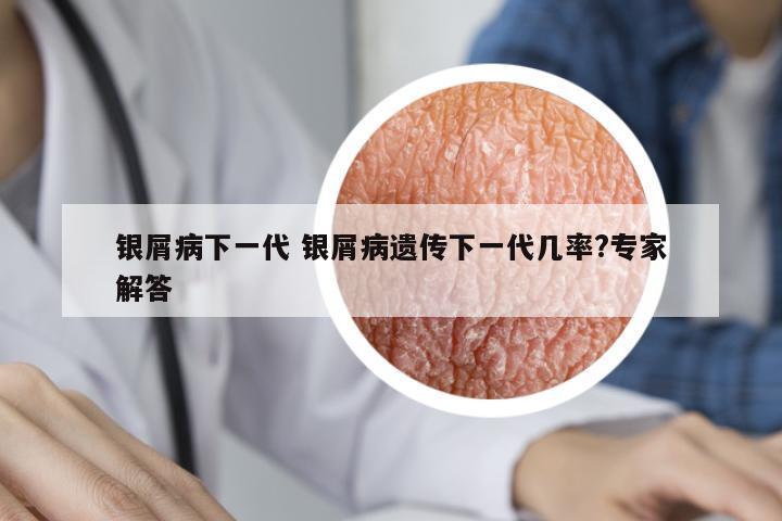 銀屑病下一代 銀屑病遺傳下一代幾率?專家解答
