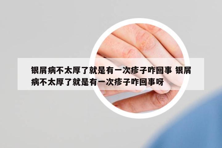 銀屑病不太厚了就是有一次疹子咋回事 銀屑病不太厚了就是有一次疹子咋回事呀