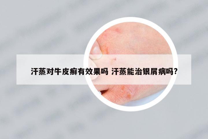 汗蒸對牛皮癬有效果嗎 汗蒸能治銀屑病嗎?