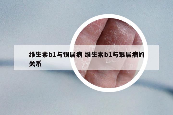 維生素b1與銀屑病 維生素b1與銀屑病的關(guān)系