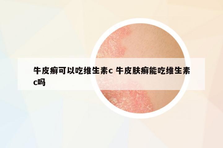 牛皮癬可以吃維生素c 牛皮膚癬能吃維生素c嗎