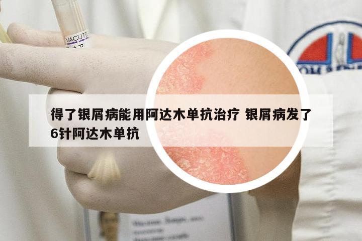 得了銀屑病能用阿達木單抗治療 銀屑病發(fā)了6針阿達木單抗