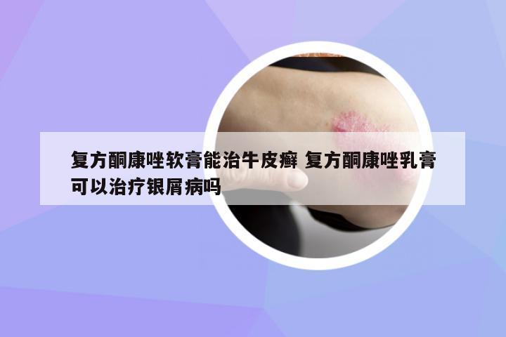 復方酮康唑軟膏能治牛皮癬 復方酮康唑乳膏可以治療銀屑病嗎