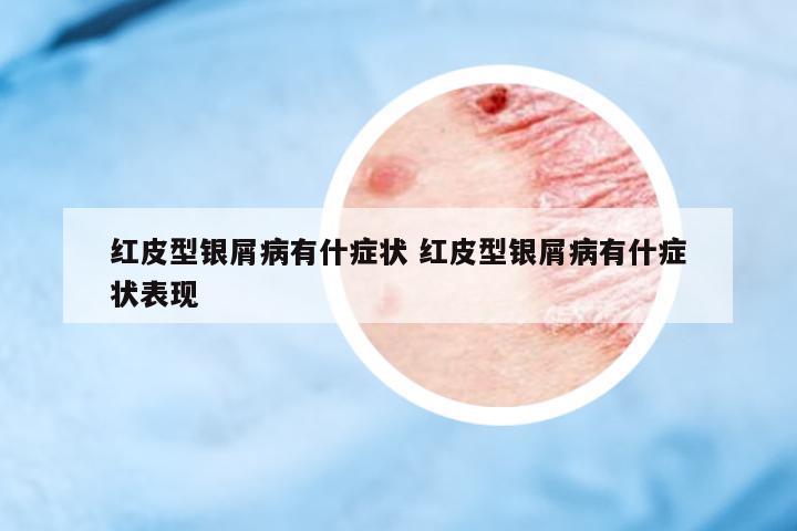 紅皮型銀屑病有什癥狀 紅皮型銀屑病有什癥狀表現(xiàn)