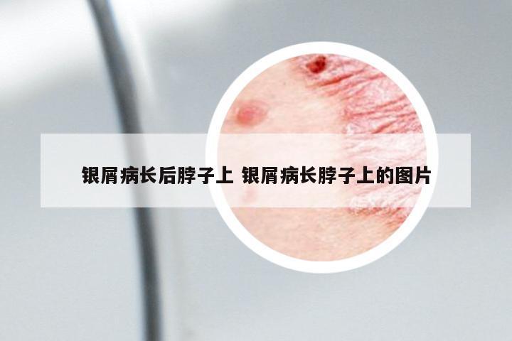 銀屑病長后脖子上 銀屑病長脖子上的圖片