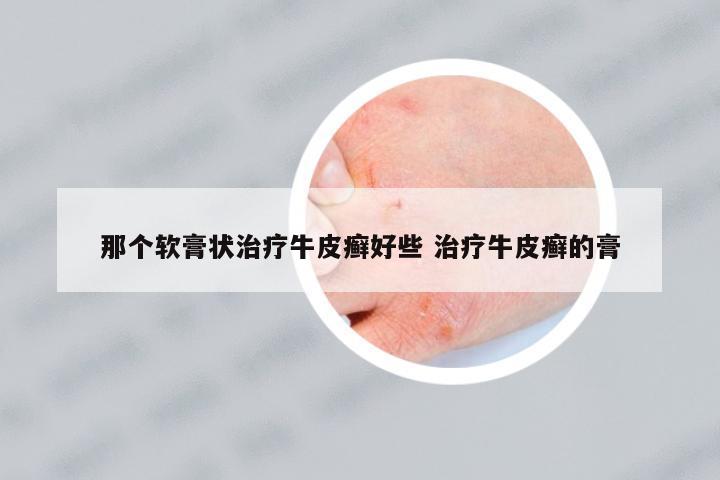 那個軟膏狀治療牛皮癬好些 治療牛皮癬的膏