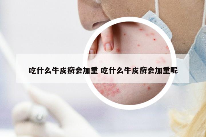 吃什么牛皮癬會加重 吃什么牛皮癬會加重呢