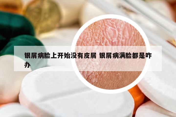 銀屑病臉上開(kāi)始沒(méi)有皮屑 銀屑病滿臉都是咋辦