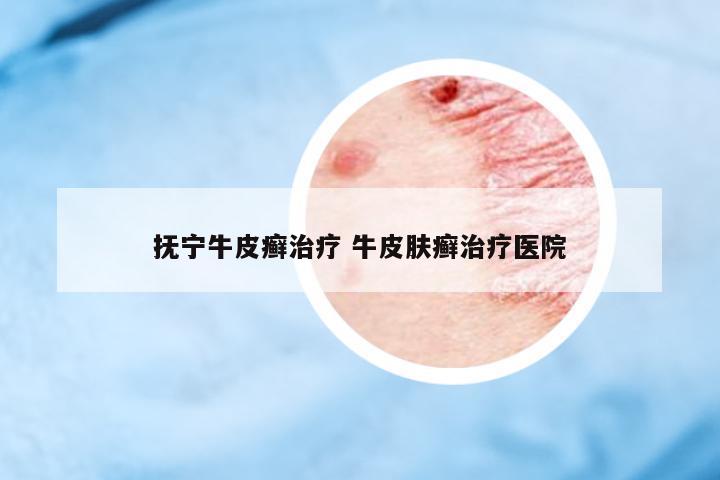 撫寧牛皮癬治療 牛皮膚癬治療醫(yī)院