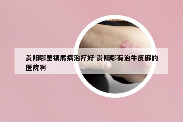 貴陽哪里銀屑病治療好 貴陽哪有治牛皮癬的醫(yī)院啊