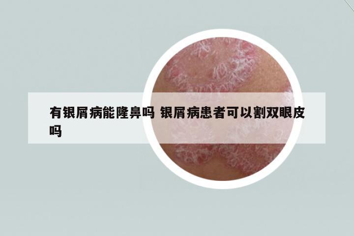 有銀屑病能隆鼻嗎 銀屑病患者可以割雙眼皮嗎