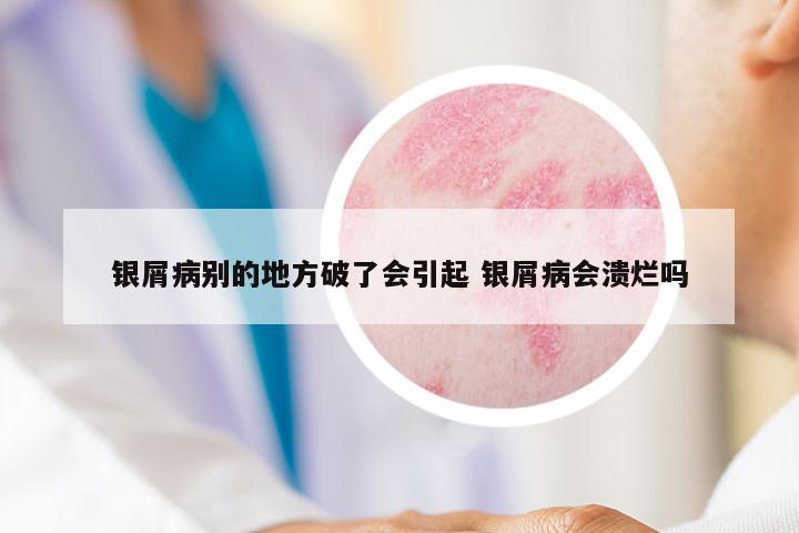 銀屑病別的地方破了會引起 銀屑病會潰爛嗎