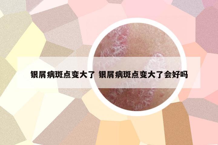 銀屑病斑點變大了 銀屑病斑點變大了會好嗎